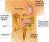 Síntomas y causas de la colitis ulcerosa
